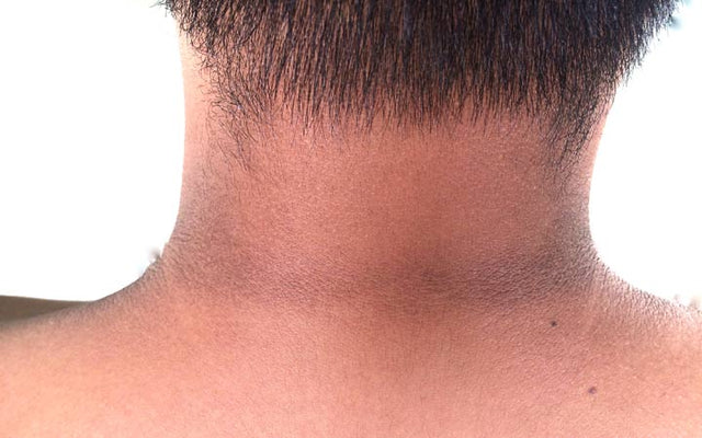 How to Get Rid of Dark Neck 6 Natural Solutions