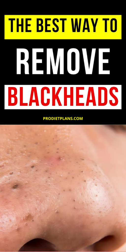 How to Get Rid of Blackheads