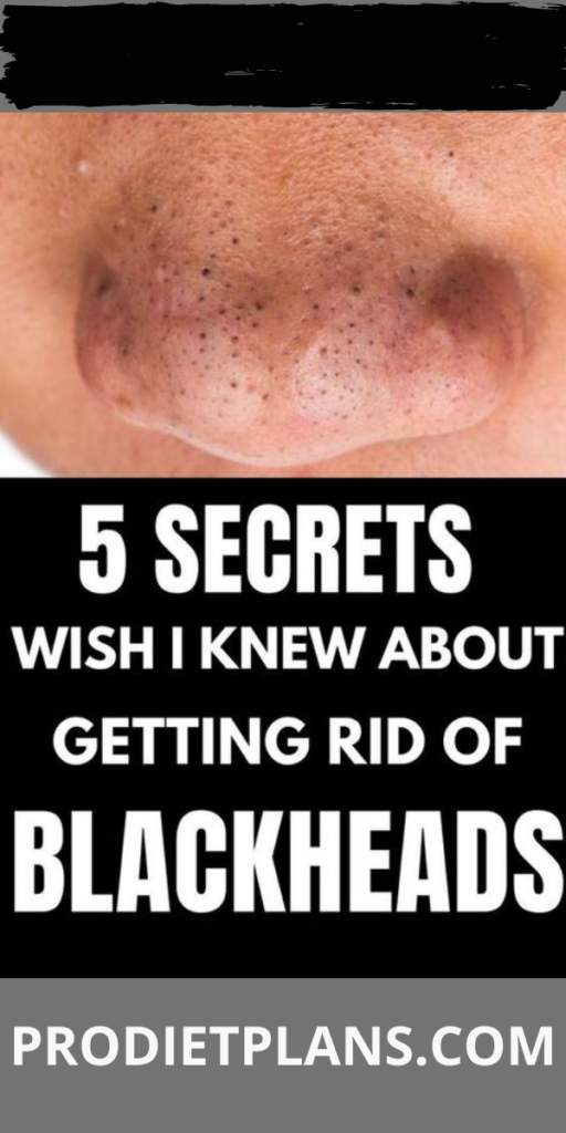 How to Get Rid of Blackheads