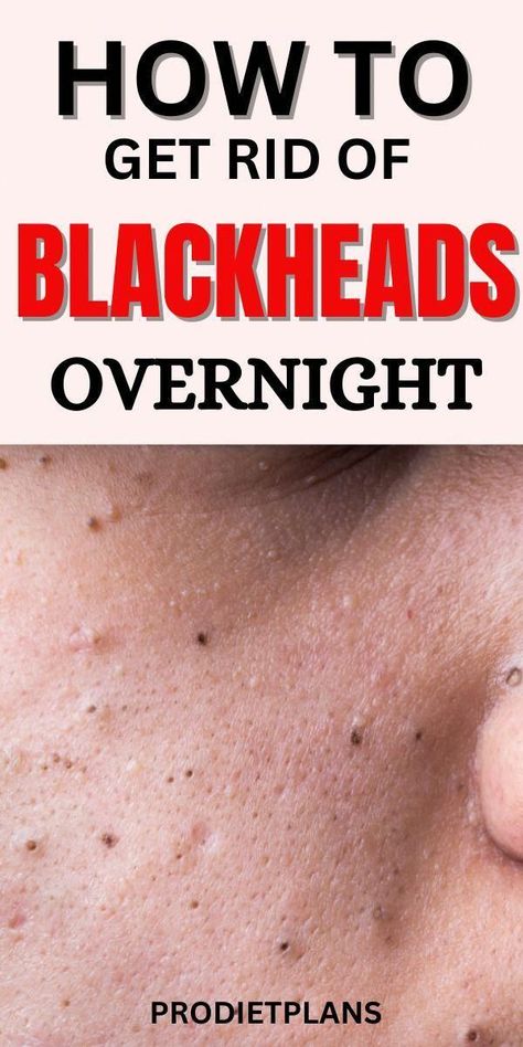 How to Get Rid of Blackheads