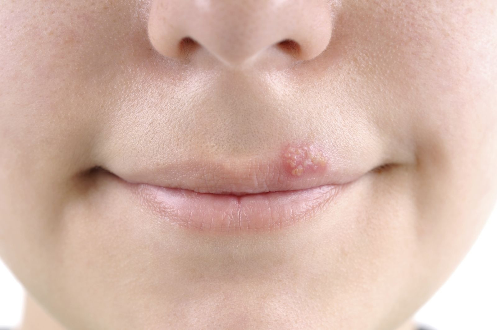 Natural Cold Sore Remedies